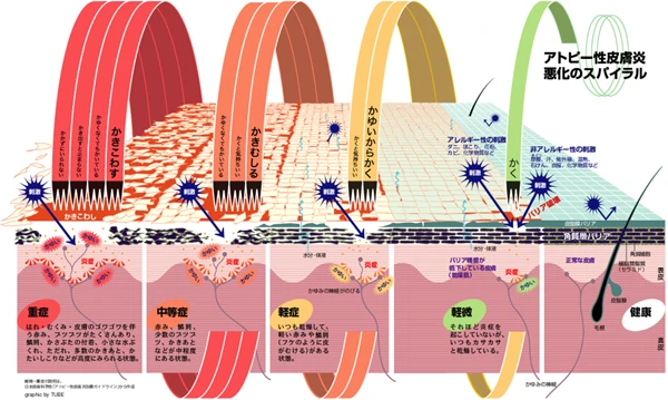 集英社 健康百科「アトピー性皮膚炎」