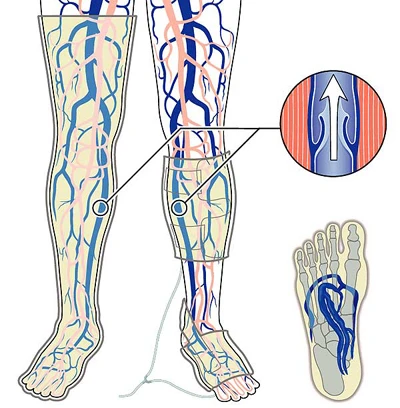 エコノミー症候群の予防グッズの仕組み