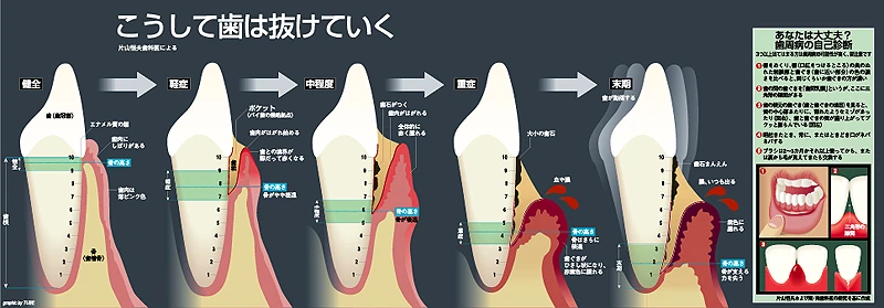 朝日新聞社 AERA「歯周病のメカニズム」SND Malofiej賞金賞受賞